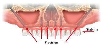 Zygoma Implants