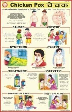 Full Color Chicken Pox Chart