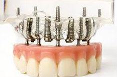 Dental Implants