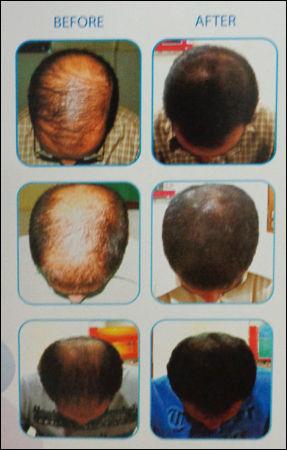 Hair Loss Treatment