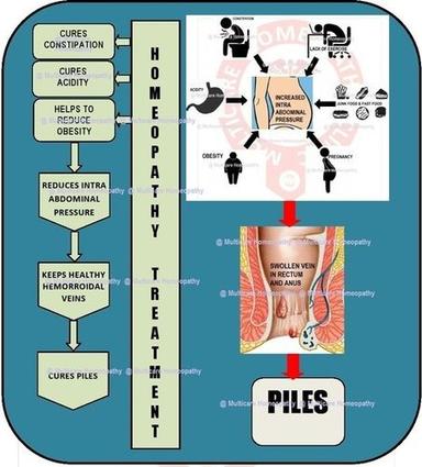 Piles Homeopathy Treatment Service