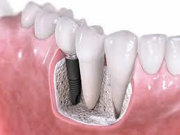 Dental Implantation'S