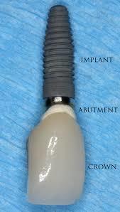 Hydroxyapatite Coated Dental Implants