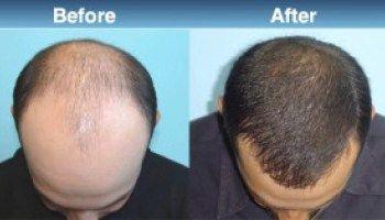 Non surgical Hair Loss Treatment