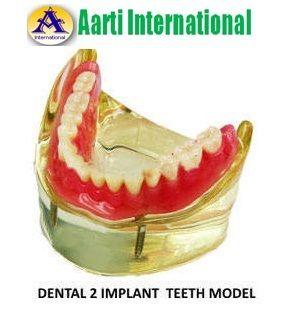  डेंटल 2 इम्प्लांट टीथ मॉडल 