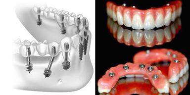 Rough Surface Basal Implants