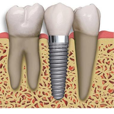 Metallic Dental Implants For Clinical Applications Use