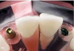 Tooth Implants