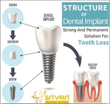 Dental Implants Strong and Permanent Solution for Tooth Loss