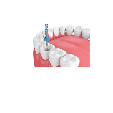 Root Canal Dental Treatment Service
